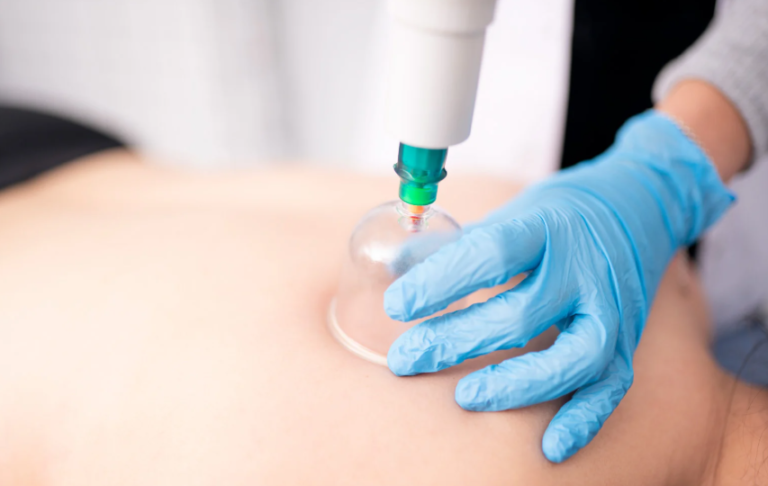 Is Wet Cupping Better Than Dry Cupping Therapy?