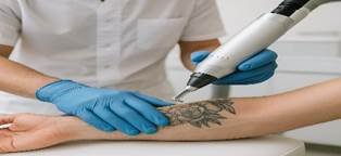 Tattoo removal: Can it be scar free and how realistic is that?