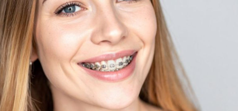 Braces With Crowns: Can You Straighten Teeth If You Have a Dental Crown?